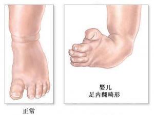 先天性马蹄内翻足的治疗原则.jpg