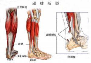 脚后跟跟腱断裂后有什么症状.jpg
