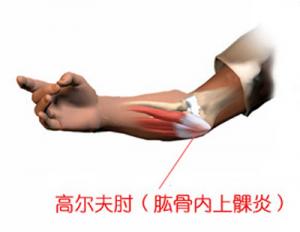网球肘的诊断标准是什么.jpg
