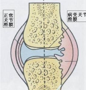 得了滑膜炎应该如何治疗.jpg