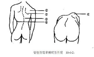 脊柱侧弯的检查方法.jpg