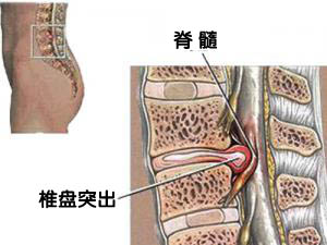 腰椎间盘突出有哪些症状.jpg