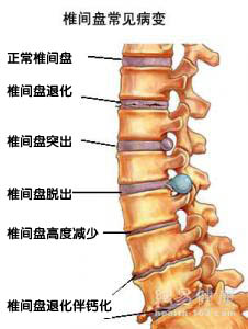 腰椎间盘突出的诊断方法.jpg